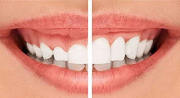 Điều trị cười hở lợi