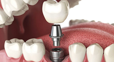 Cấy ghép implant