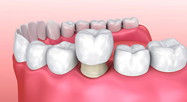 Răng sứ thẩm mỹ