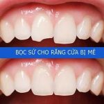 boc su rang cua dc