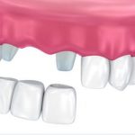 LÀM CẦU RĂNG SỨ GIÁ BAO NHIÊU THÌ HỢP LÝ? 6 gia cau rs dc