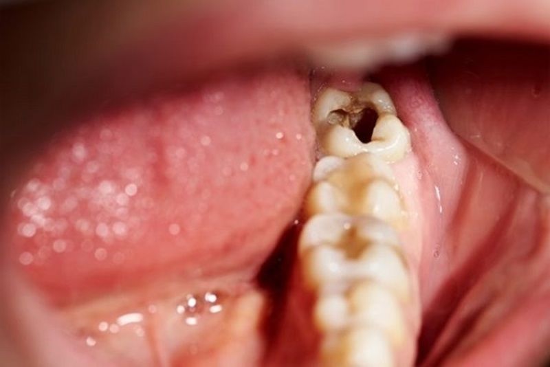 Mọc răng khôn đau mấy ngày? Cách giảm đau hiệu quả 3 moc rang khon dau may ngay cach giam dau hieu qua 2