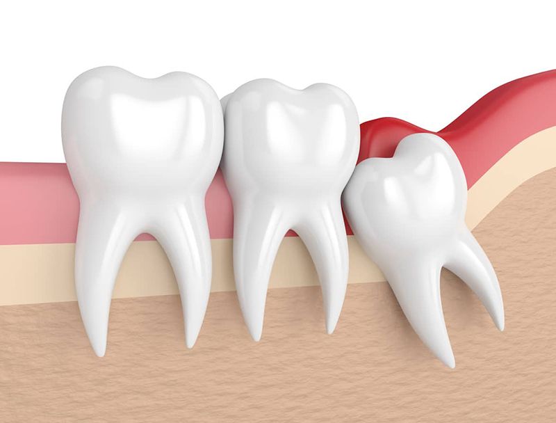 Răng khôn mọc khi nào? Những điều bạn cần lưu ý về răng khôn 1 rang khon moc khi nao nhung dieu ban can luu y ve rang khon 1