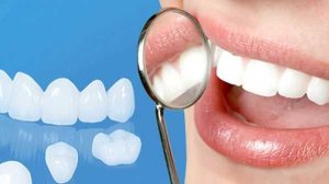 Bọc răng sứ có hại không? 2 boc rang su co hai khong 2