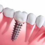 Điều trị mất răng bằng phương pháp cấy ghép răng Implant 13 dieu tri mat rang bang phuong phap cay ghep rang implant 4