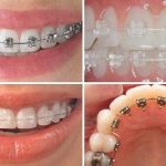 Các phương pháp niềng răng phổ biến hiện nay 1 cac phuong phap nieng rang pho bien hien nay 1