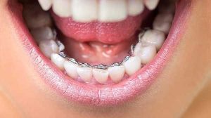 cac phuong phap nieng rang pho bien hien nay 3