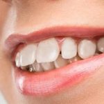 Răng hô và cách điều trị 2 rang ho va cach dieu tri 1